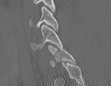 Cervical Superior Articular Facet Fracture0002